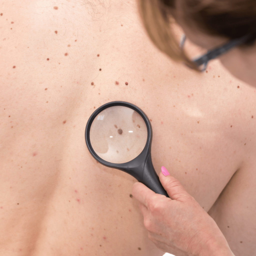 13 de Junio - Día europeo de la prevención del cáncer de piel